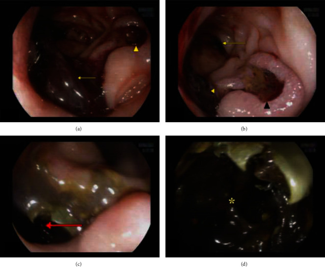 Renal Cell Carcinoma Masquerading as Acute Upper Gastrointestinal Bleeding.