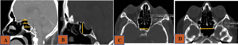 Do Anatomical Variations of Sphenoid Sinus Influence Sella Exposure and Residual Disease in Pituitary Surgery? - A Study in an Indian Population.