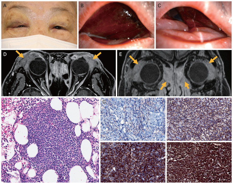 Blastic Plasmacytoid Dendritic Cell Neoplasm with Periorbital Ecchymosis and Massive Subconjunctival Hemorrhage as a Presenting Sign: A Case Report.