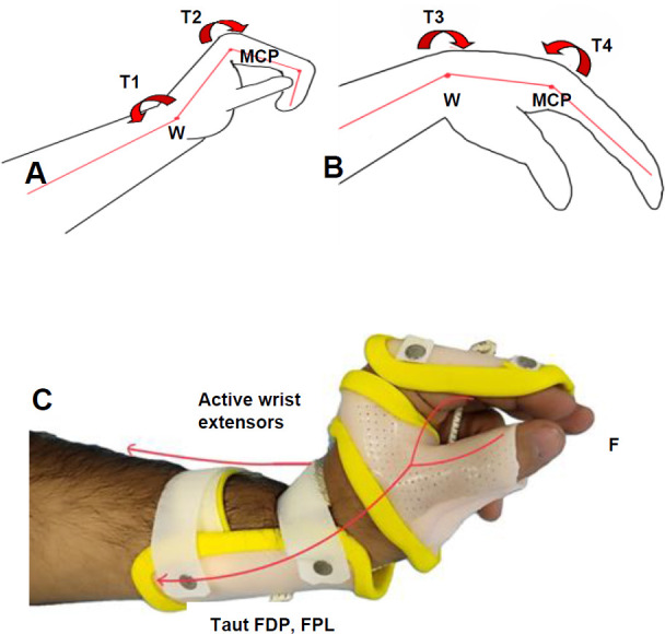 The Effect of a Modified Tenodesis Wrist-hand Orthosis on Hand Function in Patients With Tetraplegia.