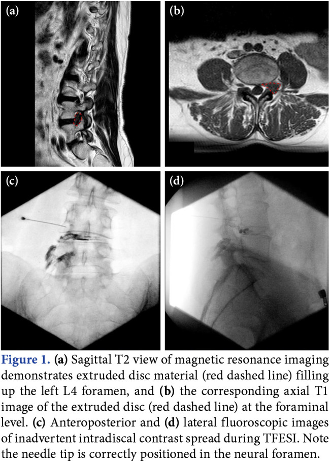 Inadvertent intradiscal flow during transforaminal epidural steroid injection.