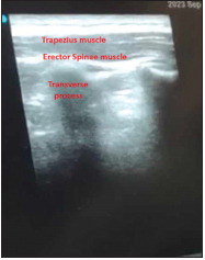 Bilateral Ultrasound-Guided Erector Spinae Plane Block for Management of Acute Postoperative Surgical Pain After Pediatric Cardiac Surgeries Through a Midline Sternotomy.