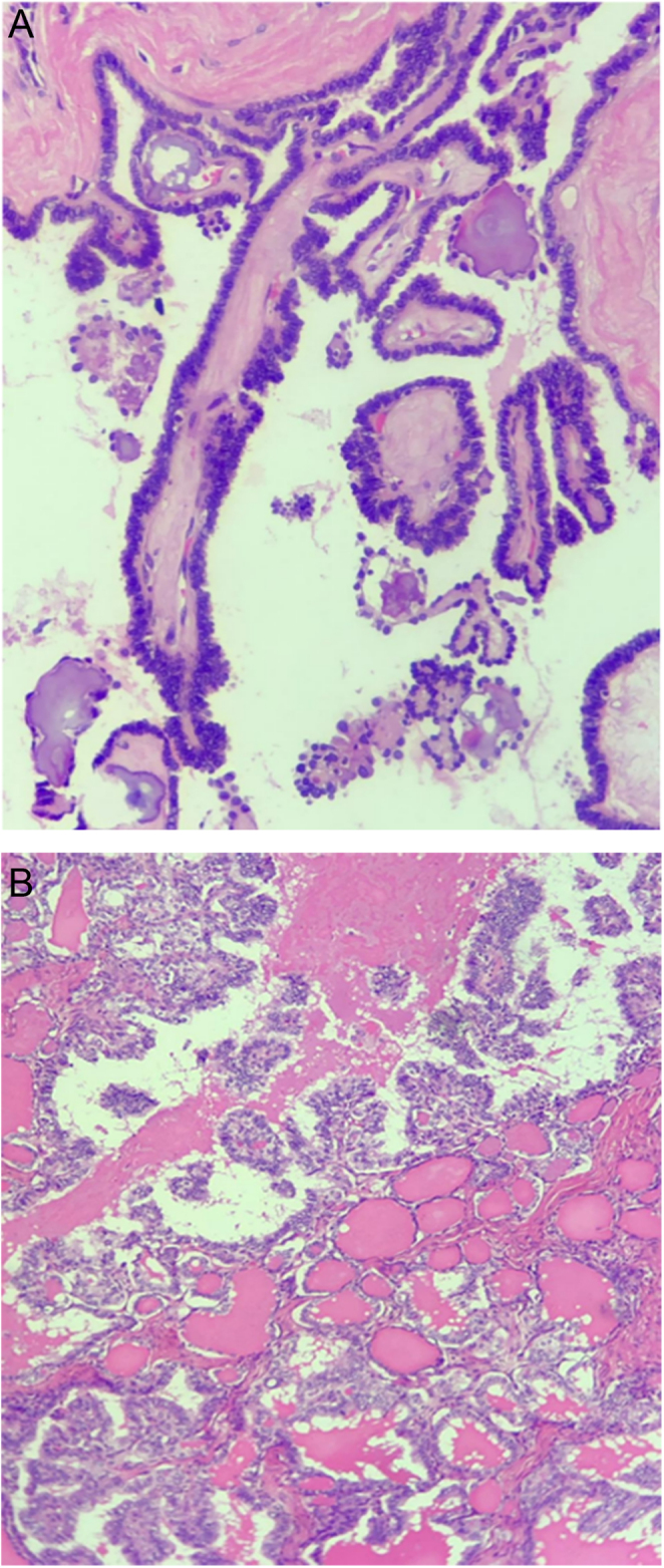 Hyperthyroidism in thyroid carcinoma originating in struma ovarii.