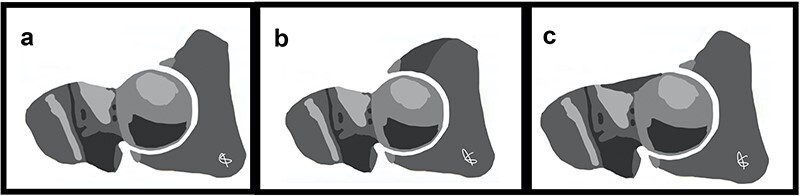 Review of femoroacetabular impingement syndrome.
