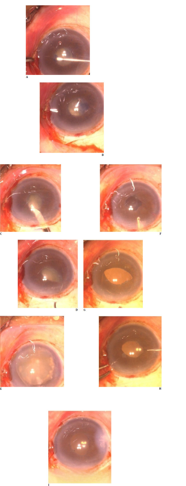 A case series on minor incision cataract surgery in small pupil without any aids.