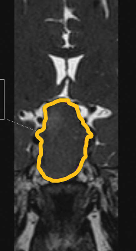 Do Anatomical Variations of Sphenoid Sinus Influence Sella Exposure and Residual Disease in Pituitary Surgery? - A Study in an Indian Population.
