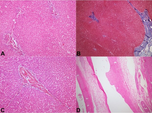 Explant pathology in Biliary Atresia post Kasai procedure: a tale of two livers.