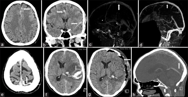 Functional outcome predictors and recanalization in cerebral venous thrombosis: A single-center cross-sectional study.
