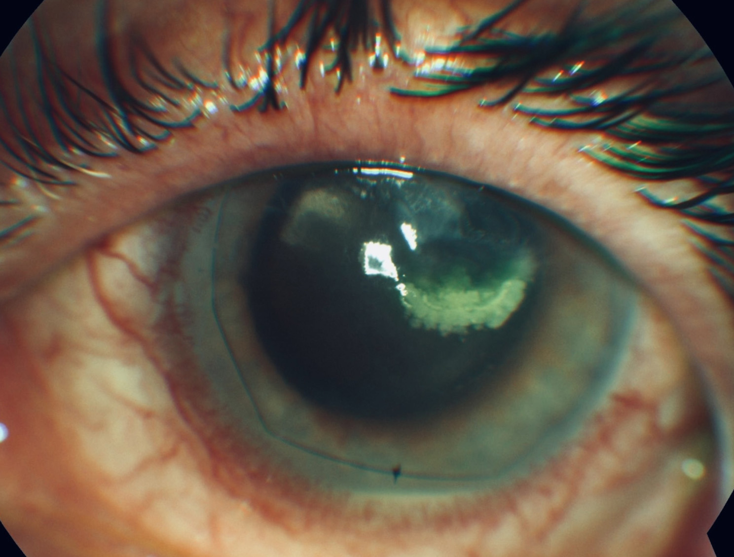 Successful treatment of Keratitis caused by Mycobacterium chelonae and an overview of previous cases in Europe.