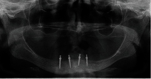 Traumatic Ulceration of the Vestibular Mucous Membrane After Insertion of Four Mini-Implants in the Atrophied Mandible: A Case Report.