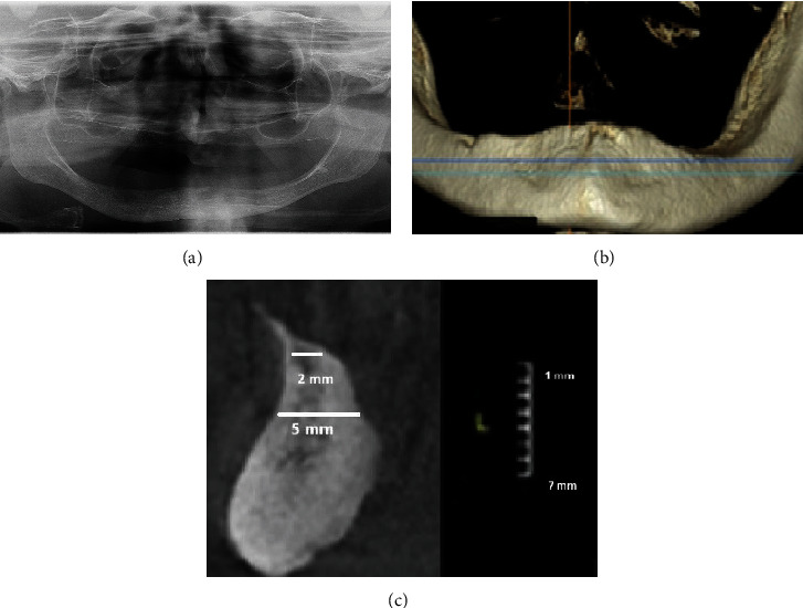 Traumatic Ulceration of the Vestibular Mucous Membrane After Insertion of Four Mini-Implants in the Atrophied Mandible: A Case Report.