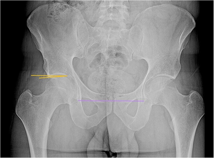 Review of femoroacetabular impingement syndrome.