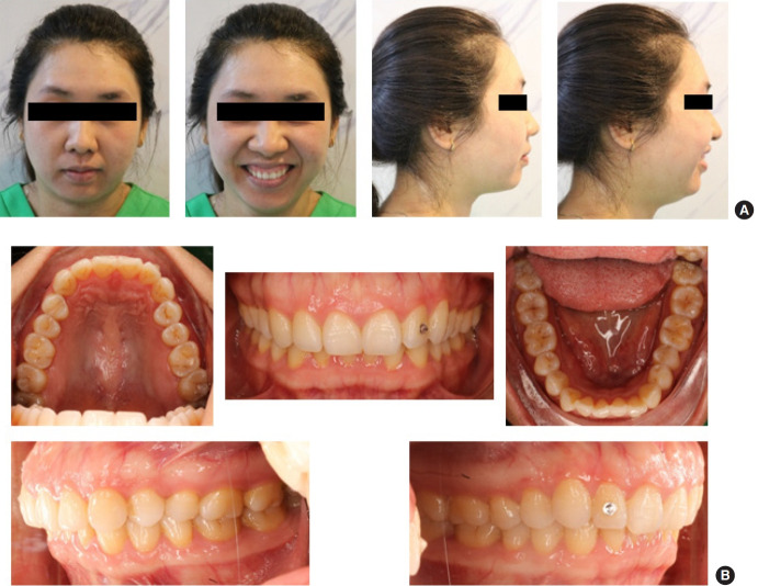 Improvements of facial profile and smile aesthetic using temporary anchorage devices and botulinum toxin: a case report.