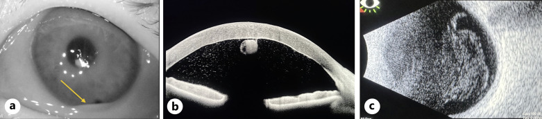 Visual Recovery and Endothelial Repopulation after DMEK Graft Removal and Vitrectomy for Late Endophthalmitis: A Case Report.