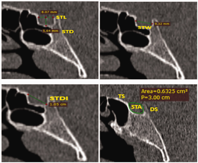 Correlation between sphenoid sinus pneumatization and sella turcica dimensions using computed tomography.