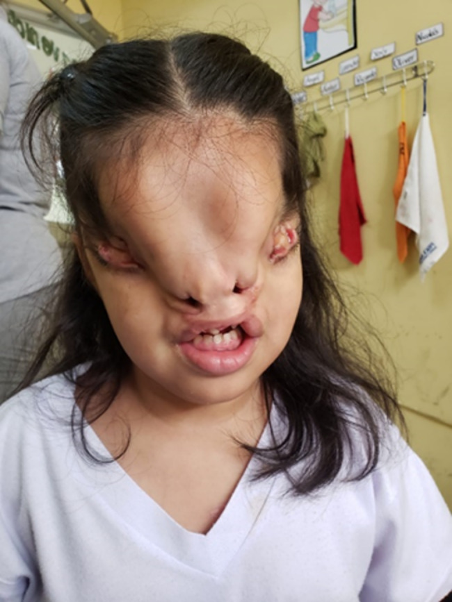 Detection of regions of homozygosity in an unusual case of frontonasal dysplasia.