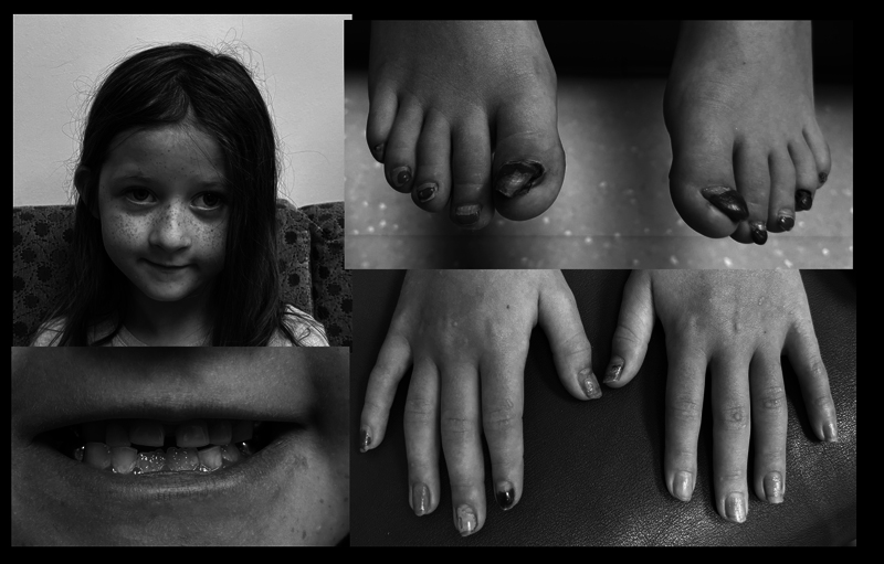 Case Report: Alpha6 Integrin Disorder Presenting in Childhood with Nail Dysplasia and Onycholysis But No History of Fragile or Bullous Skin Changes.