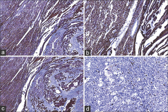 Spindle cell variant of ameloblastic carcinoma: A diagnostic challenge.
