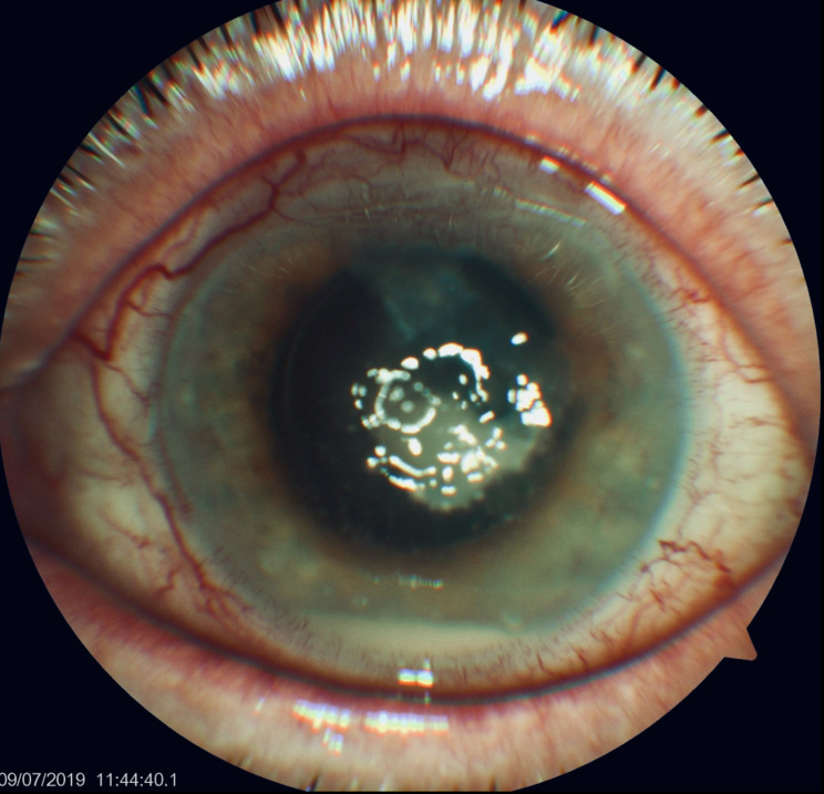 Successful treatment of Keratitis caused by Mycobacterium chelonae and an overview of previous cases in Europe.
