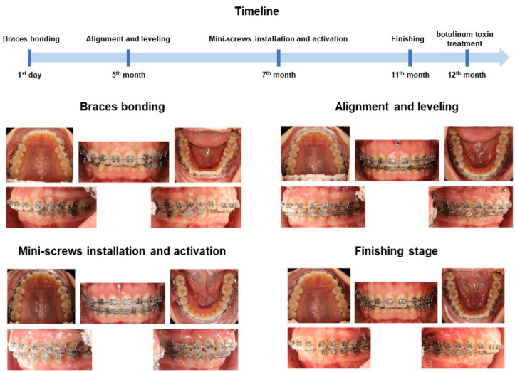 Improvements of facial profile and smile aesthetic using temporary anchorage devices and botulinum toxin: a case report.