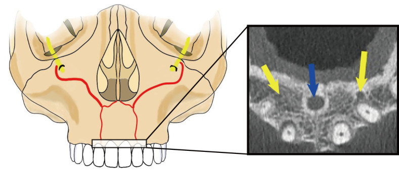 [Anatomy and function of the canalis sinuosus and its injury prevention and treatment strategies in implant surgery].