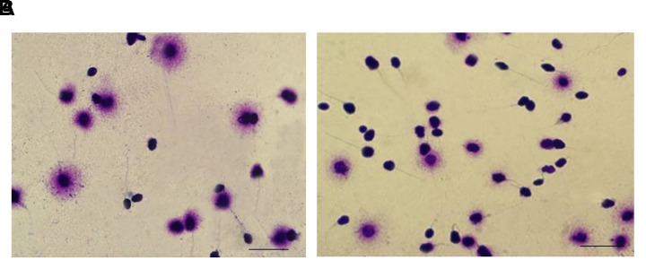 The Relationship between The Expression of Sperm <i>MicroRNA-149b</i> and <i>34c</i> and Sperm Quality in Men with Oligoasthenoteratozoospermia in Endometriosis.