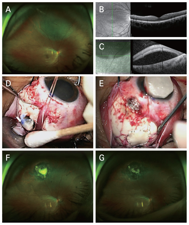Scleral Rupture during Scleral Buckle and Cryotherapy for Rhegmatogenous Retinal Detachment: A Case Report.