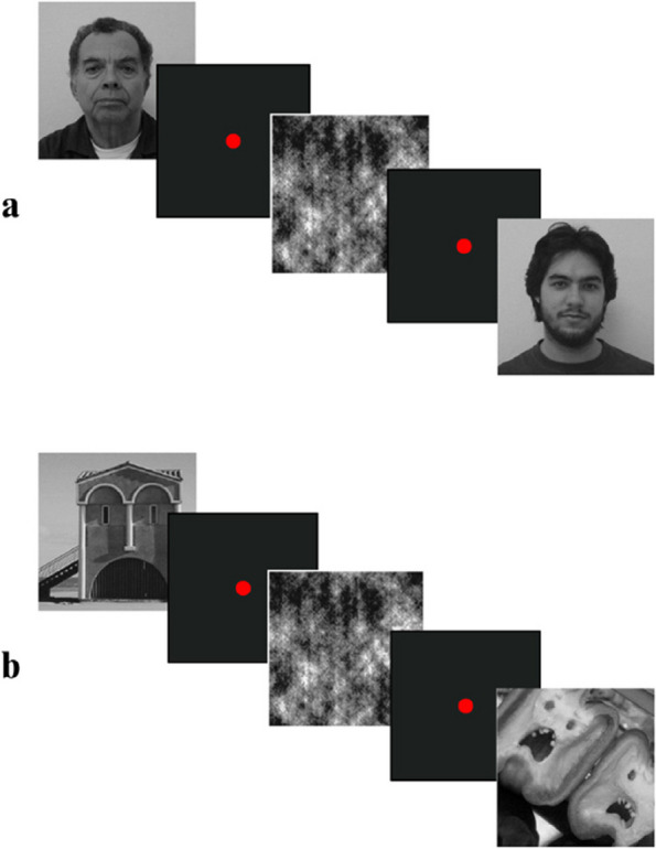 Face and face pareidolia in patients with temporal lobe epilepsy indicates different neural processing: an event-related potential study.