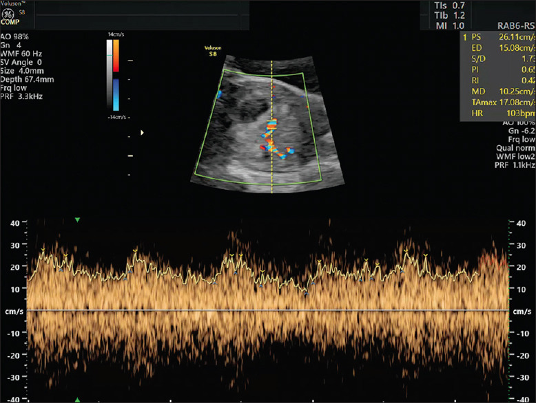 First-trimester Doppler Ultrasound for Predicting Successful Management of Pregnancy with Recurrent Pregnancy Losses Due to Antiphospholipid Syndrome and Thrombophilia: A Cohort Study.