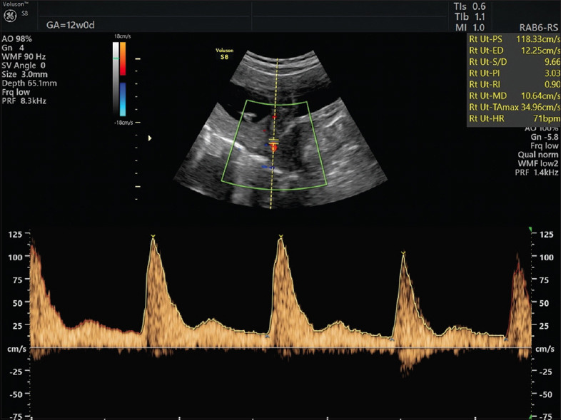 First-trimester Doppler Ultrasound for Predicting Successful Management of Pregnancy with Recurrent Pregnancy Losses Due to Antiphospholipid Syndrome and Thrombophilia: A Cohort Study.