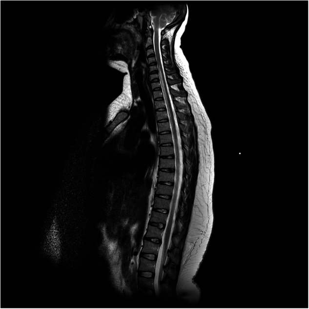 Non-surgical spinal cord infarction: case series & long-term follow-up of functional outcome.
