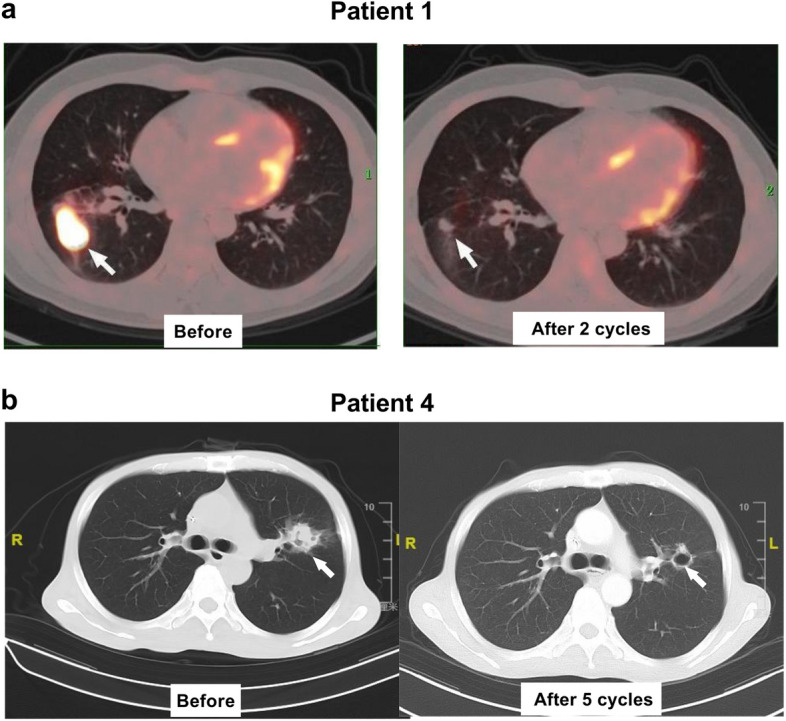 PD-1 inhibitors plus chemotherapy for refractory EBV-positive DLBCL: a retrospective analysis.