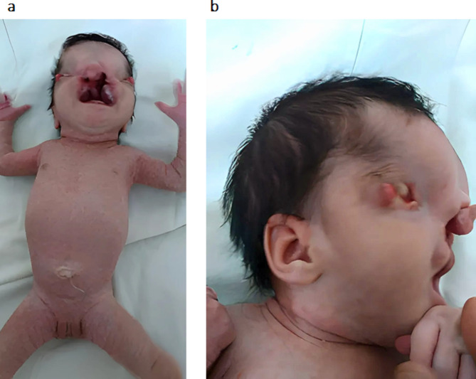 Detection of regions of homozygosity in an unusual case of frontonasal dysplasia.