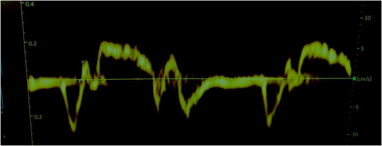 Improvements of right ventricular function after intervention with CPAP in patients with obstructive sleep apnoea.