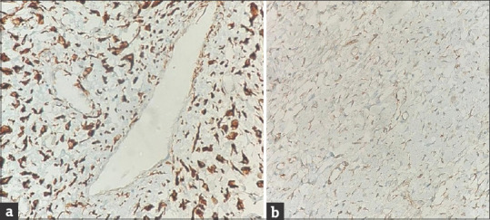 Cervical Superficial Myofibroblastoma Presenting as a Polyp: A Rare Benign Entity.