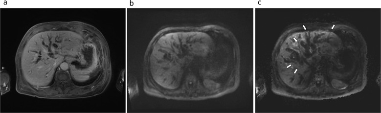 Evaluating Biliary Malignancy with Measured and Calculated Ultra-high b-value Diffusion-weighted MR Imaging at 3T.