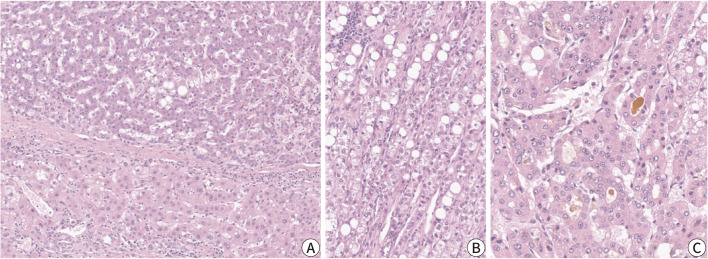 The histopathological and molecular heterogeneity of hepatocellular carcinoma: a narrative review.