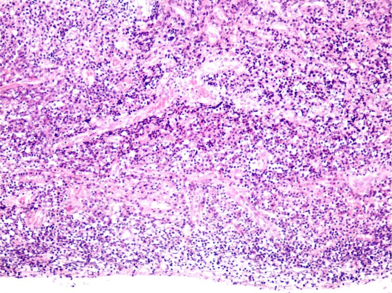 Biology of recurrent cholesteatoma in a Romanian young patient - a case report.