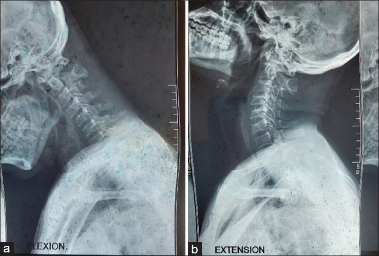 Atlantoaxial fixation for treatment of syringobulbia and syringomyelia: Case report and literature review.