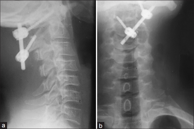 Atlantoaxial fixation for treatment of syringobulbia and syringomyelia: Case report and literature review.