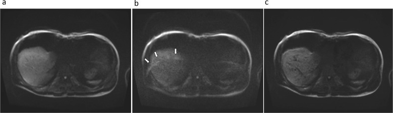 Evaluating Biliary Malignancy with Measured and Calculated Ultra-high b-value Diffusion-weighted MR Imaging at 3T.