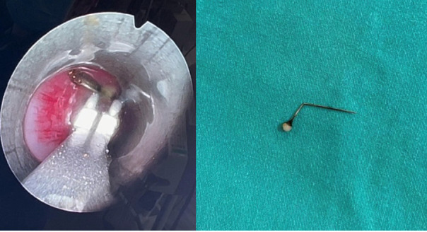 A Rare Case of a Child with Bended Scarf-Pin in Left Bronchus: Case Report with Systematic Review And Meta-Analysis.