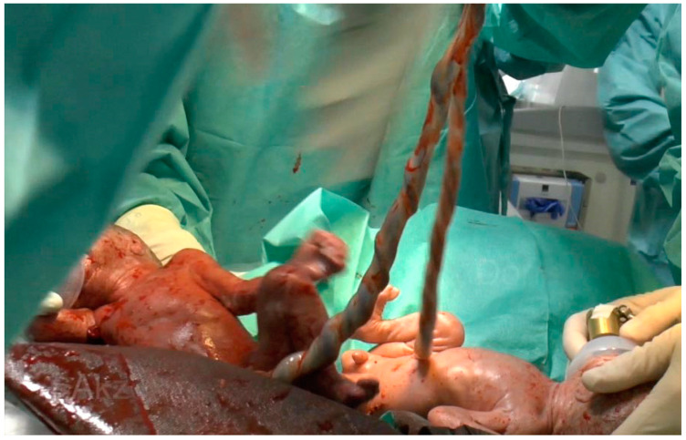 Selective Extrauterine Placental Perfusion in Monochorionic Twins Is Feasible-A Case Series.