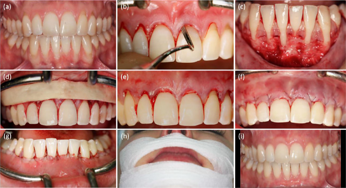 Digital workflow to assess gingival recession coverage independently of the cemento-enamel Junction: a prospective clinical study using the modified coronally advanced tunnel technique with porcine dermal matrix.