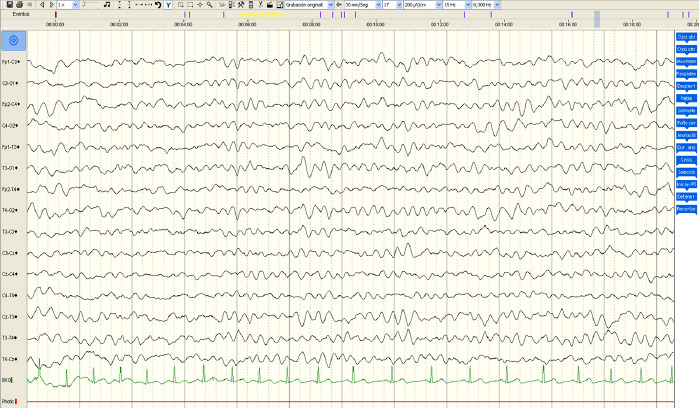 [Epilepsy in Angelman syndrome and the most common electroencephalographic findings].