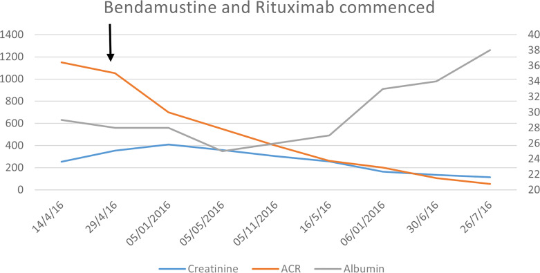 Recurrent Fibrillary Glomerulonephritis Secondary to Chronic Lymphocytic Leukemia: Remission of Kidney Disease with Ibrutinib.