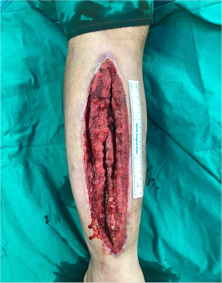 Expedited infection control and wound healing by combining Matriderm<sup>®</sup>, a dermal matrix, and Stimulan<sup>®</sup> absorbable antibiotic beads: a case report.