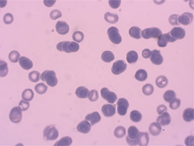 Acute Kidney Failure Confused with Thrombocytopenic Thrombocytic Purpura in Malaria: A Case Report.