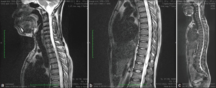 Atlantoaxial fixation for treatment of syringobulbia and syringomyelia: Case report and literature review.