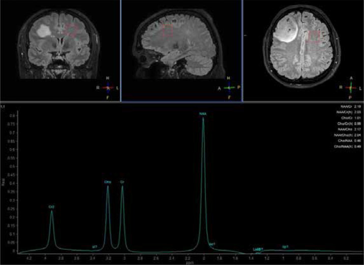 The peritumoral brain zone in glioblastoma: a review of the pretreatment approach.